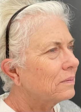 Laser Skin Before & After