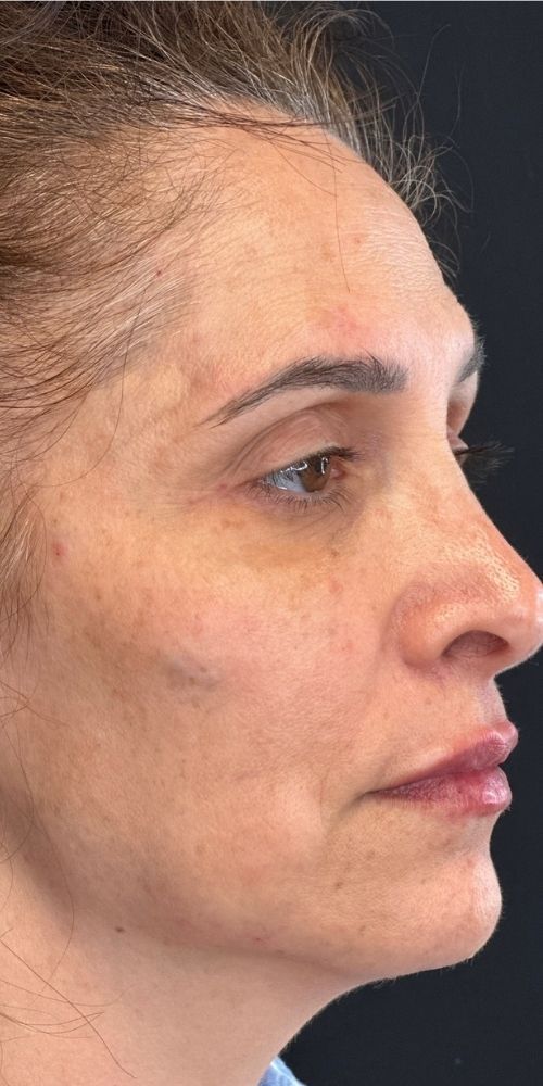 Full Face Correction Before & After