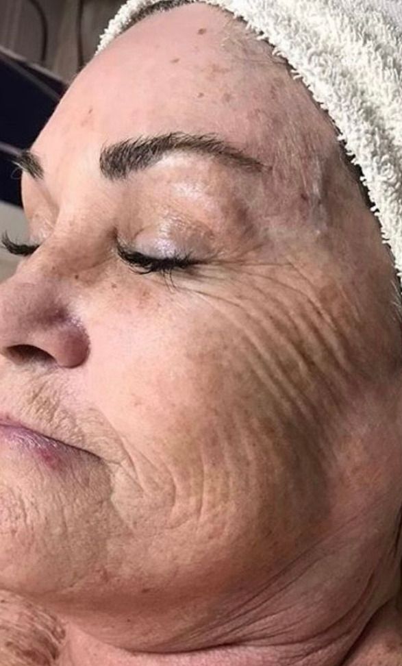 Advanced Facials Before & After