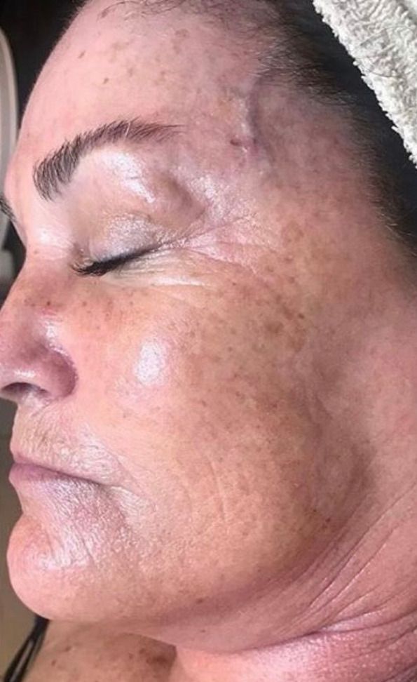 Advanced Facials Before & After