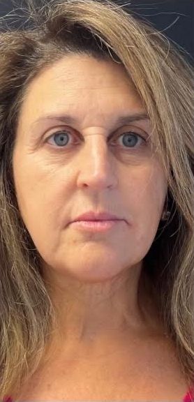 Morpheus Before & After