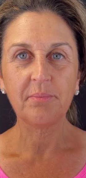 Morpheus Before & After