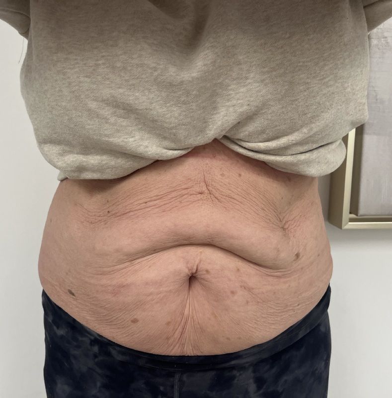 Morpheus8 Before & After