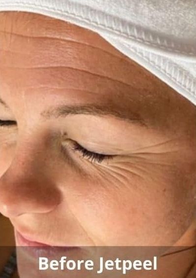 Jet Peel  Before & After