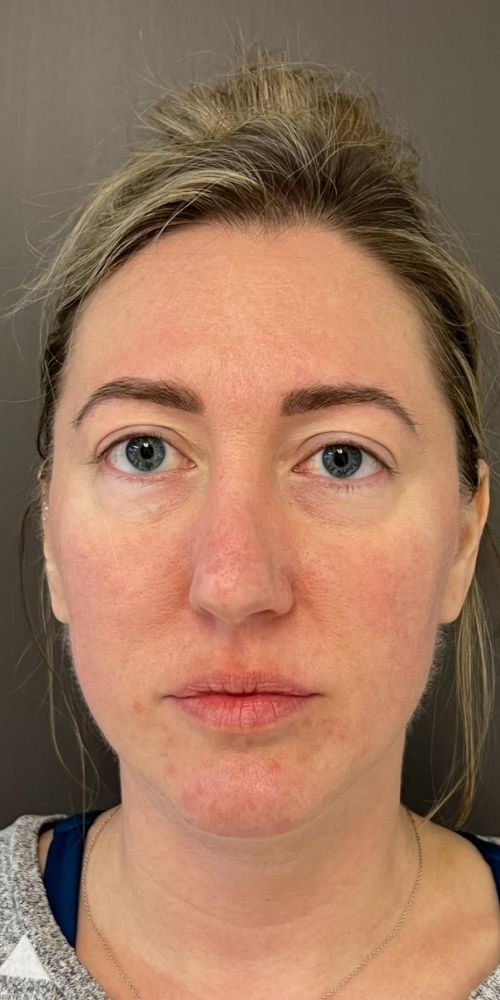 Dermal Filler Before & After