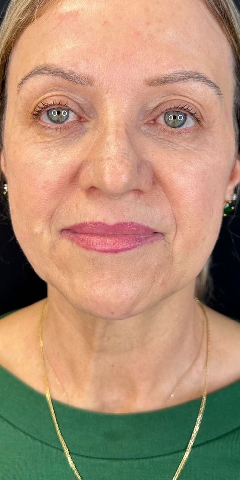 Dermal Filler Before & After