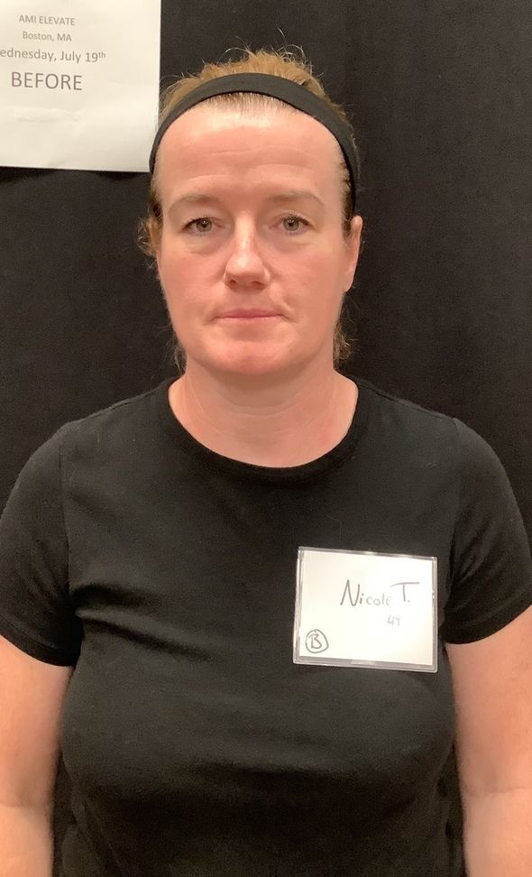 Dermal Filler Before & After