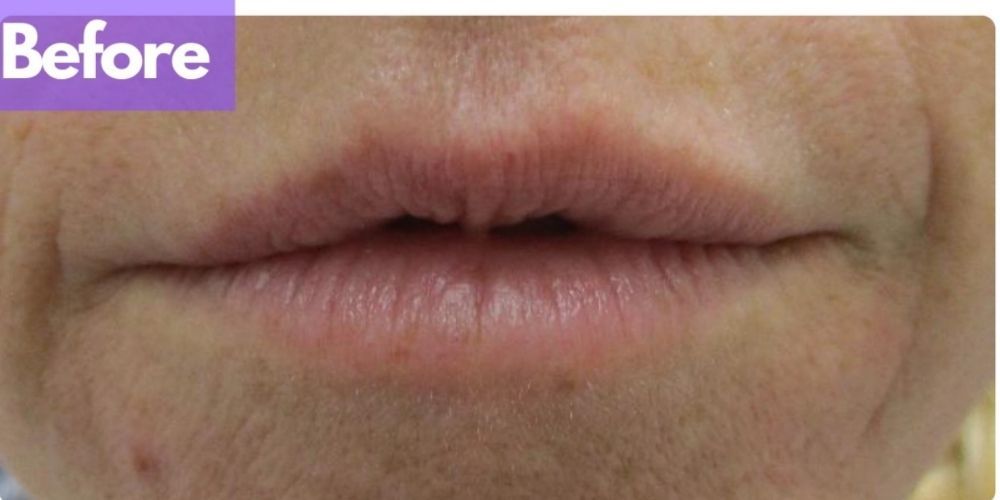 Lip Filler Before & After
