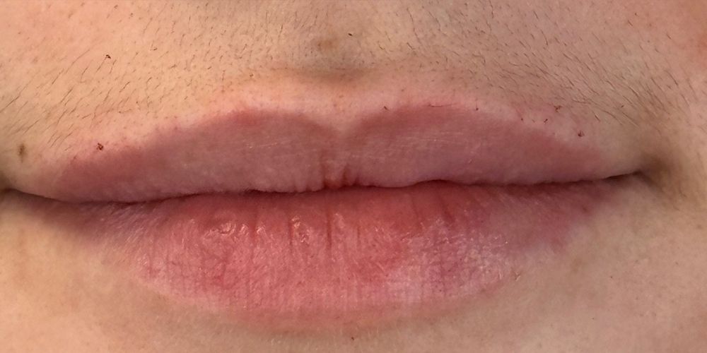 Lip Filler Before & After