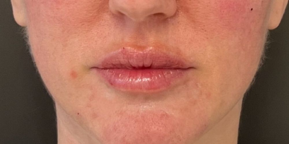 Lip Filler Before & After